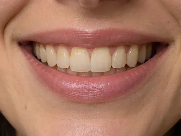 Imagen ilustrativa de una sonrisa antes del tratamiento de blanqueamiento dental