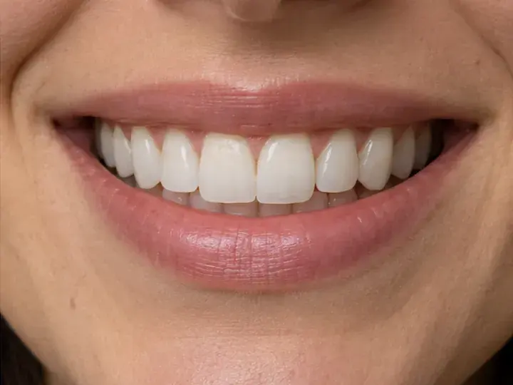 Imagen ilustrativa de la misma sonrisa después del tratamiento de blanqueamiento dental