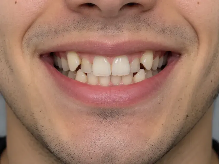 Imagen ilustrativa de una sonrisa antes del tratamiento de ortodoncia