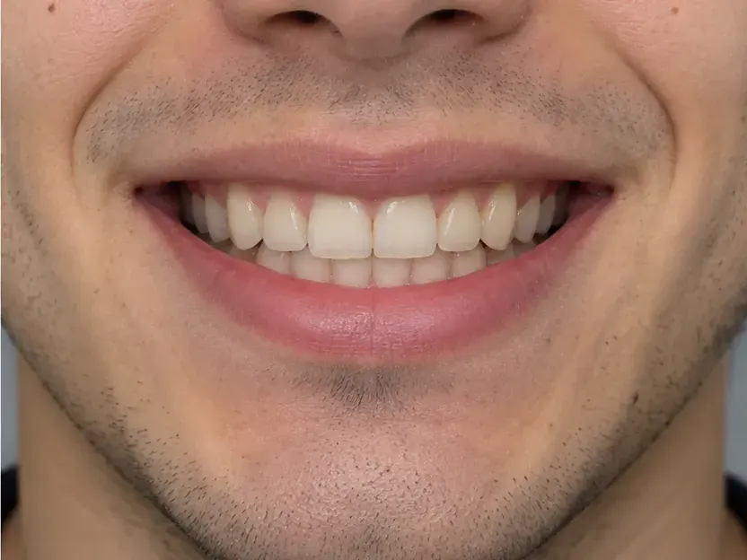 Imagen ilustrativa de la misma sonrisa después del tratamiento de ortodoncia