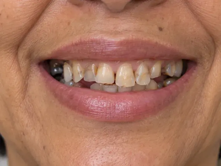 Imagen ilustrativa de una sonrisa antes del tratamiento de rehabilitación oral
