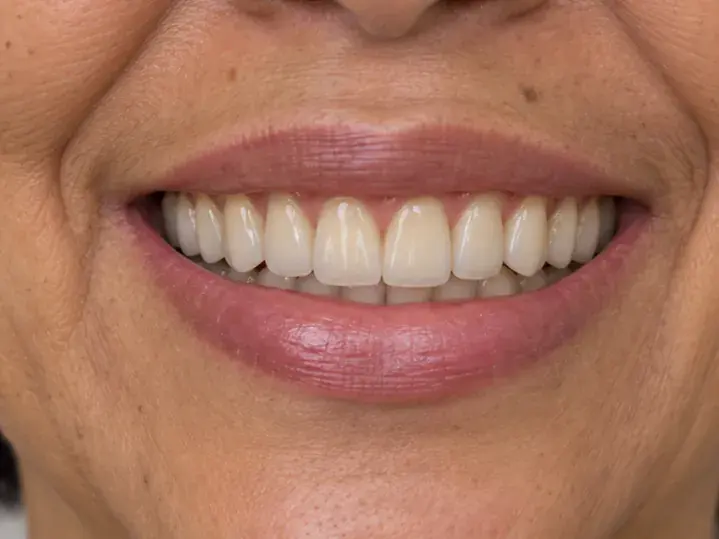 Imagen ilustrativa de la misma sonrisa después del tratamiento de rehabilitación oral