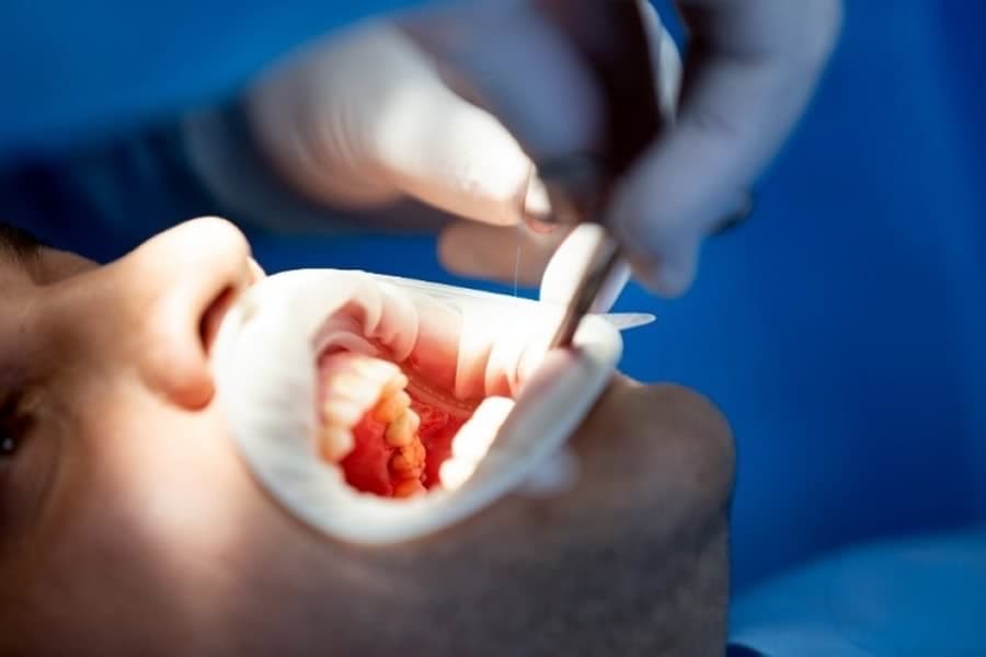 Tratamiento de conductos en curso, con abrebocas y lima de endodoncia
