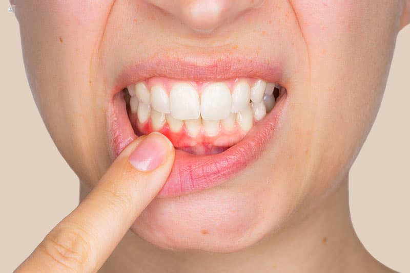 Encía enrojecida por gingivitis señalada por la paciente