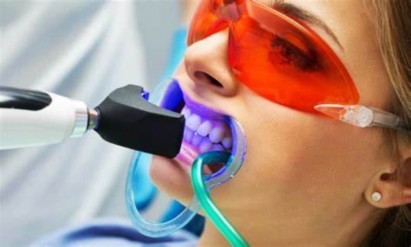 Blanqueamiento dental con lámpara LED y gafas de protección