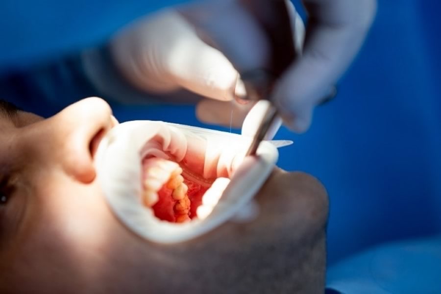 Tratamiento de conductos en curso, con abrebocas y lima de endodoncia